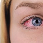Red Eyes and Blood Pressure: What's the Link?
