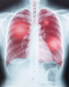 What is Pulmonary Hypertension?